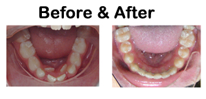 Image: Pediatric Dental Center of Tampa - Orthodontics