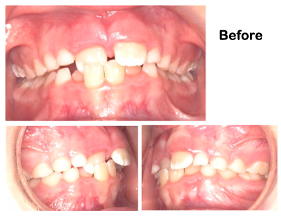 Image: Pediatric Dental Center of Tampa - Orthodontics